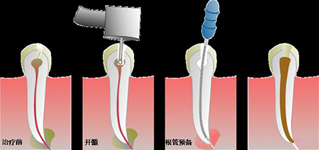 江宁根管治疗要多少钱